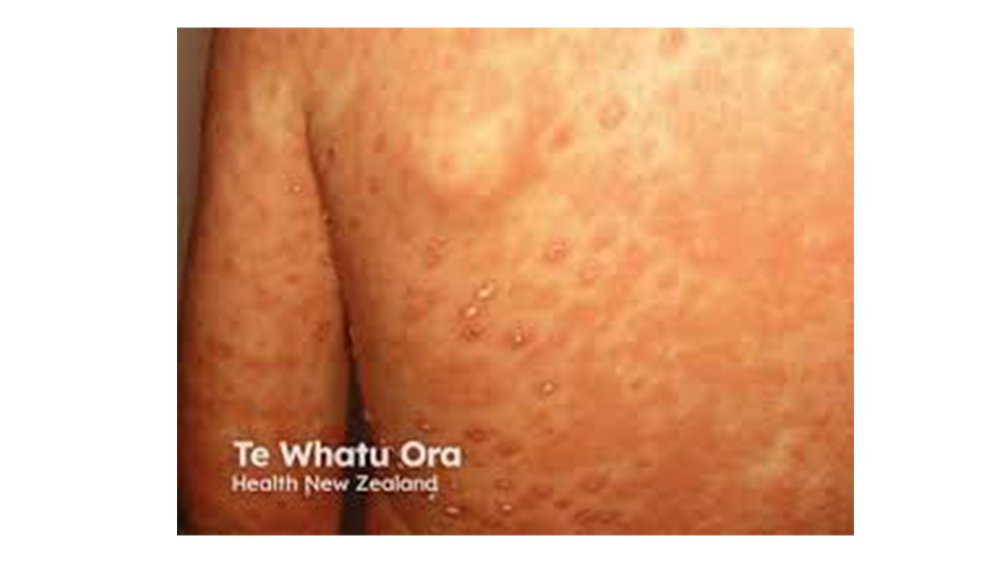 Te Whatu Ora chicken pox