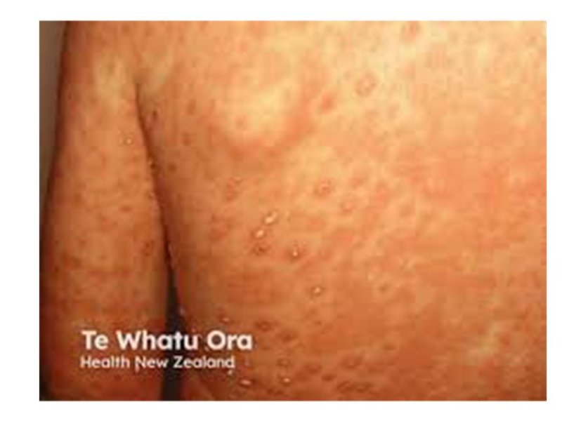 Te Whatu Ora chicken pox