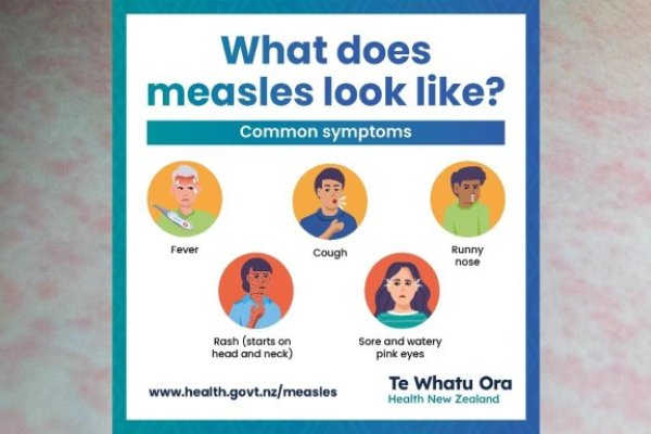 measles