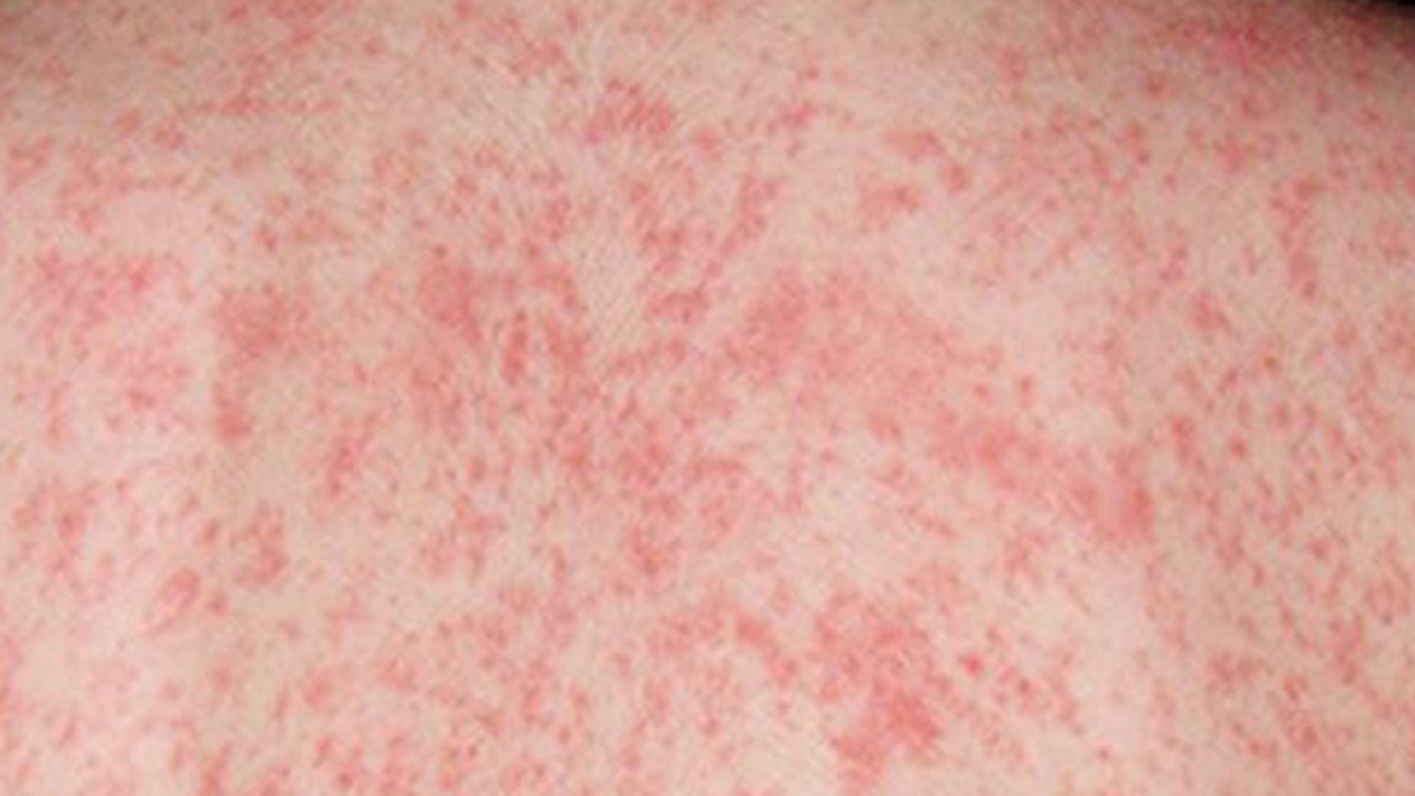 Measels Rash Texture Measles Fact Sheet - Green Bay High School